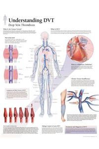 Understanding DVT Laminated Poster