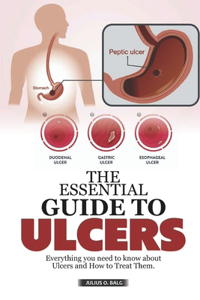 The Essential Guide to Ulcers