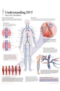 Understanding DVT Paper Poster