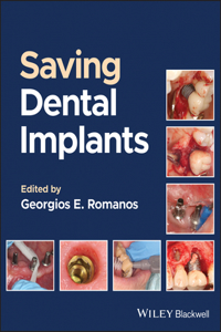 Long-Term Survival of Dental Implants