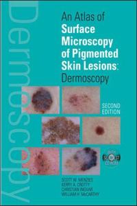 An Atlas of Surface Microscopy of Pigmented Skin Lesions