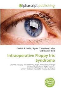 Intraoperative Floppy Iris Syndrome