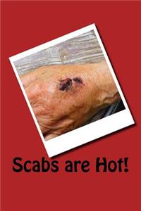 Scabs are Hot!