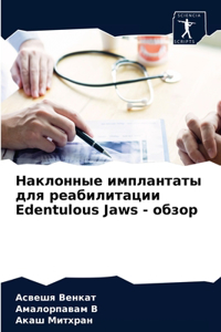 Наклонные имплантаты для реабилитации Edentulous Jaw