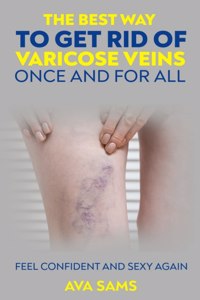 Best Way to Get Rid of Varicose Veins Once and For All