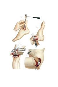 Resections Performed on the Lower Extremity Composition Notebook