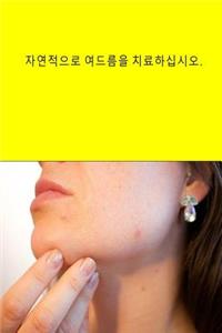 Cure Your Acne Naturally (Korean)