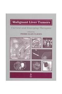 Malignant Liver Tumors