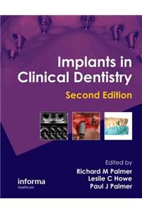 Implants in Clinical Dentistry