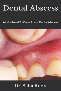 Dental Abscess