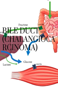 Bile duct cancer (Cholangiocarcinoma)