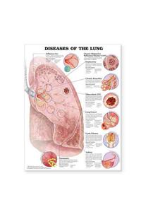 Diseases of the Lung Anatomical Chart