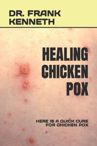 Healing Chicken Pox