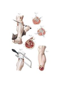 Amputation of the Leg Composition Notebook
