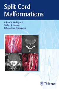 Split Cord Malformations