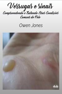 Verrugas e Sinais
