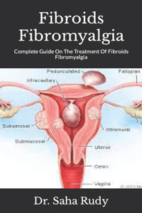 Fibroids Fibromyalgia