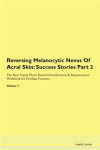 Reversing Melanocytic Nevus Of Acral Skin