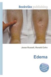 Edema