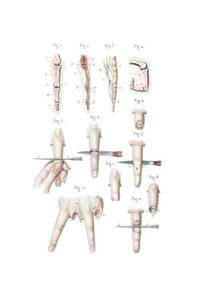Disarticulation of Phalanges and Finger