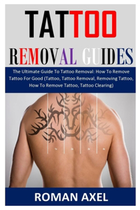 Tattoo Removal Guide