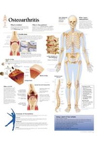 Understanding Osteoarthritis Chart