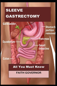 Sleeve Gastrectomy