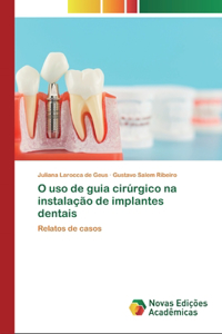 O uso de guia cirúrgico na instalação de implantes dentais