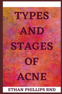 Types and Stages of Acne