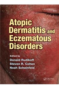 Atopic Dermatitis and Eczematous Disorders