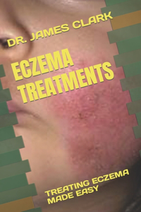 Eczema Treatments