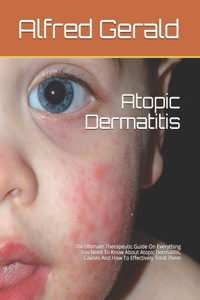 Atopic Dermatitis