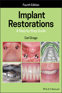 Implant Restorations – A Step–by–Step Guide