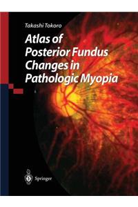 Atlas of Posterior Fundus Changes in Pathologic Myopia