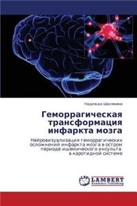 Gemorragicheskaya Transformatsiya Infarkta Mozga