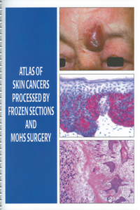 Atlas of Skin Cancers Processed by Frozen Sections and MOHS Surgery [With CDROM]
