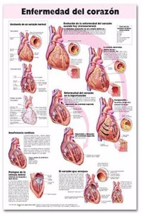 Heart Disease Anatomical Chart in Spanish (Enfermedad del corazon)