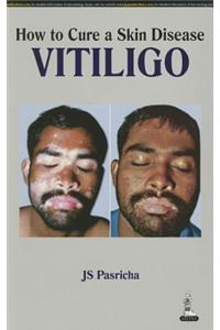 How to Cure a Skin Disease: Vitiligo