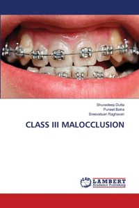 Class III Malocclusion