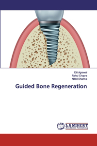 Guided Bone Regeneration