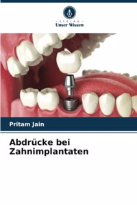 Abdrücke bei Zahnimplantaten