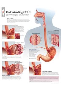 Understanding GERD (Gastroesophageal Reflux Disease) Laminated Poster