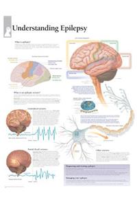 Understanding Epilepsy Laminated Poster