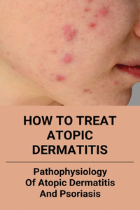 How To Treat Atopic Dermatitis