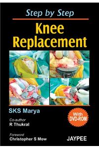 Step by Step Knee Replacement