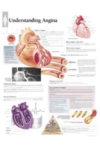 Understanding Angina Laminated Poster