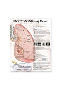 Understanding Lung Cancer Anatomical Chart