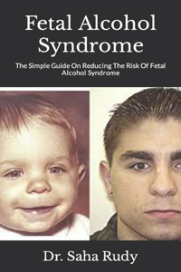 Fetal Alcohol Syndrome