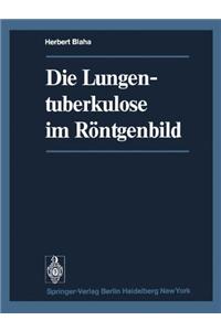 Die Lungentuberkulose Im Rontgenbild