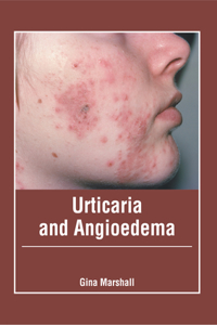 Urticaria and Angioedema